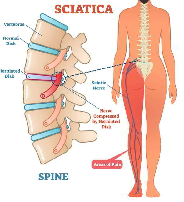 What Kind of Chair Is Best for Sciatica?